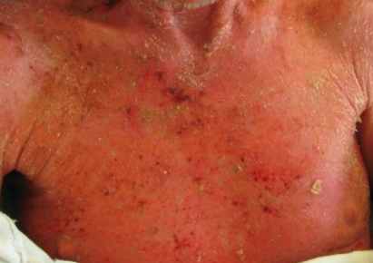 Sézary Syndrome Thumb