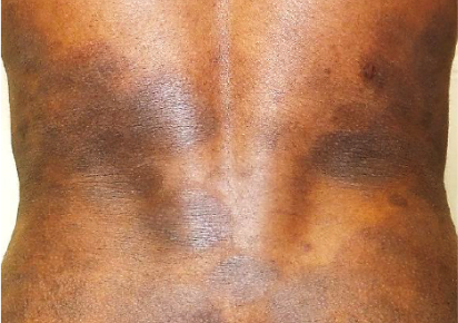 Mycosis Fungoides Thumb